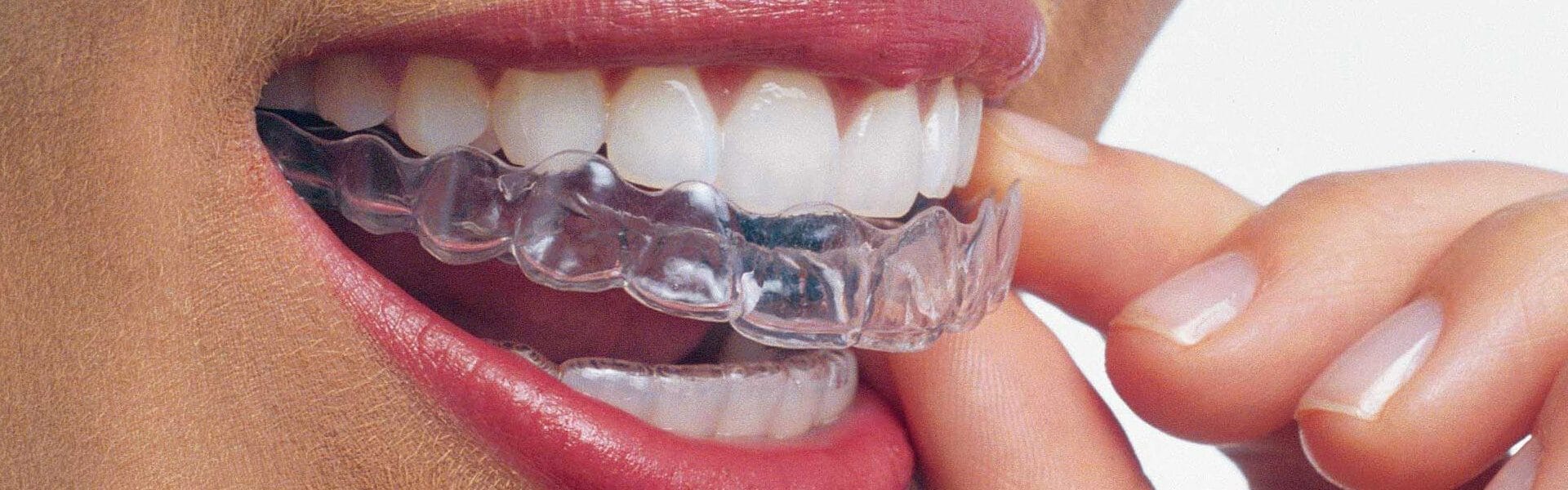 Invisalign vs. Smile Direct Club What’s the Difference? EaDo Family Dental